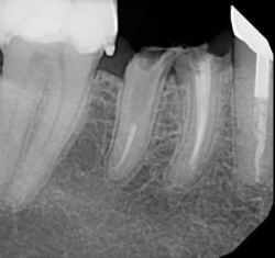 Fig 1. Recurrent decay revealed clinically